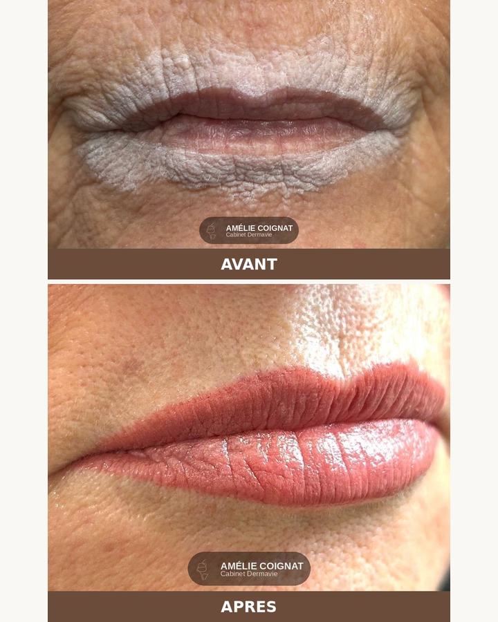 Mature, avant/après - Cabinet Dermavie Sainte-Maxime