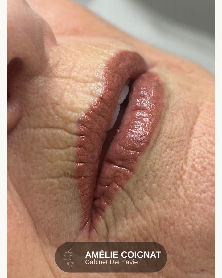 Mature technique contour - Cabinet Dermavie Sainte-Maxime