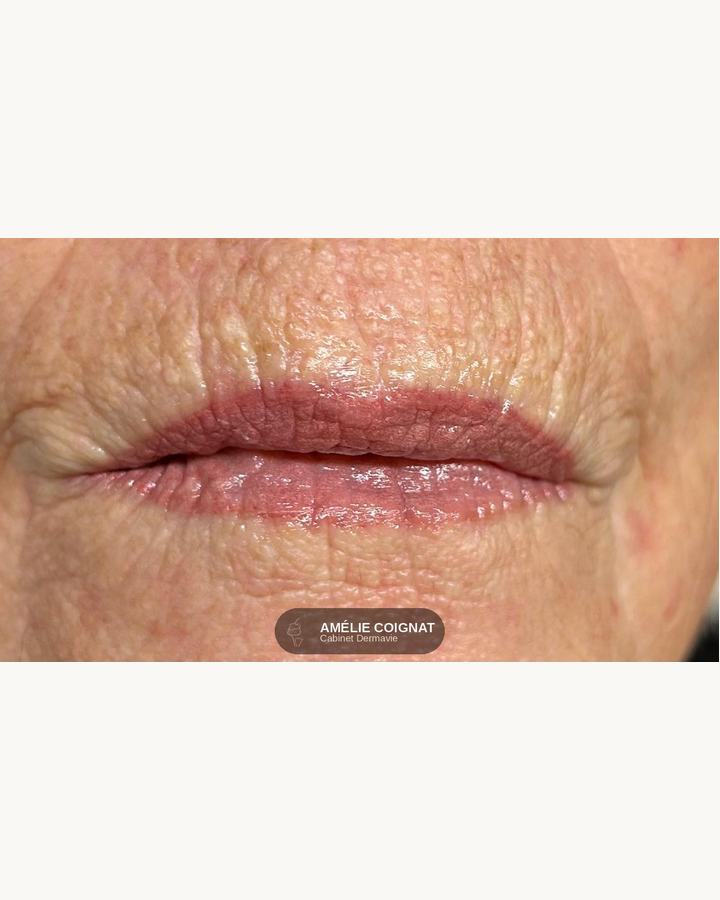 Nude peau mature - Cabinet Dermavie Sainte-Maxime