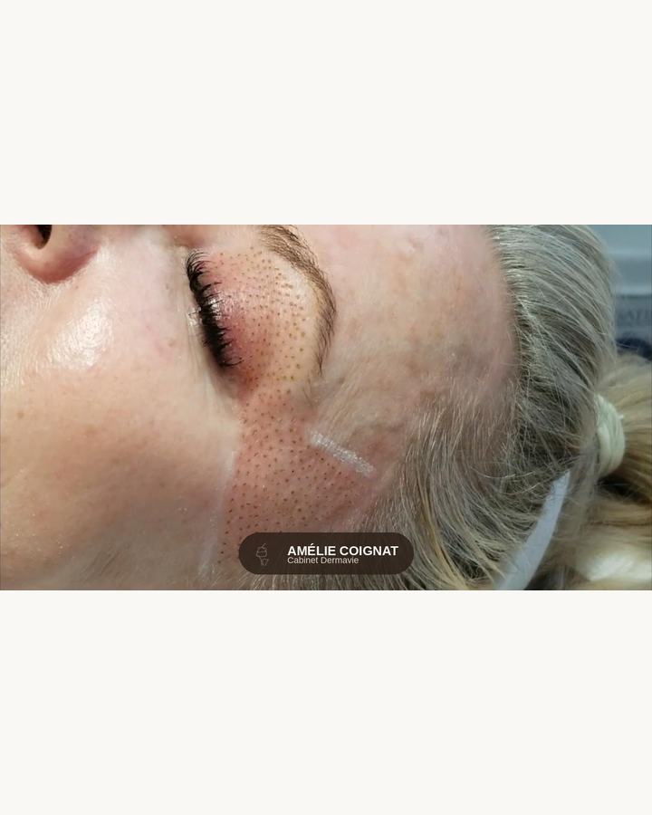 Plasma pen pattes doies detail - Cabinet Dermavie Sainte-Maxime