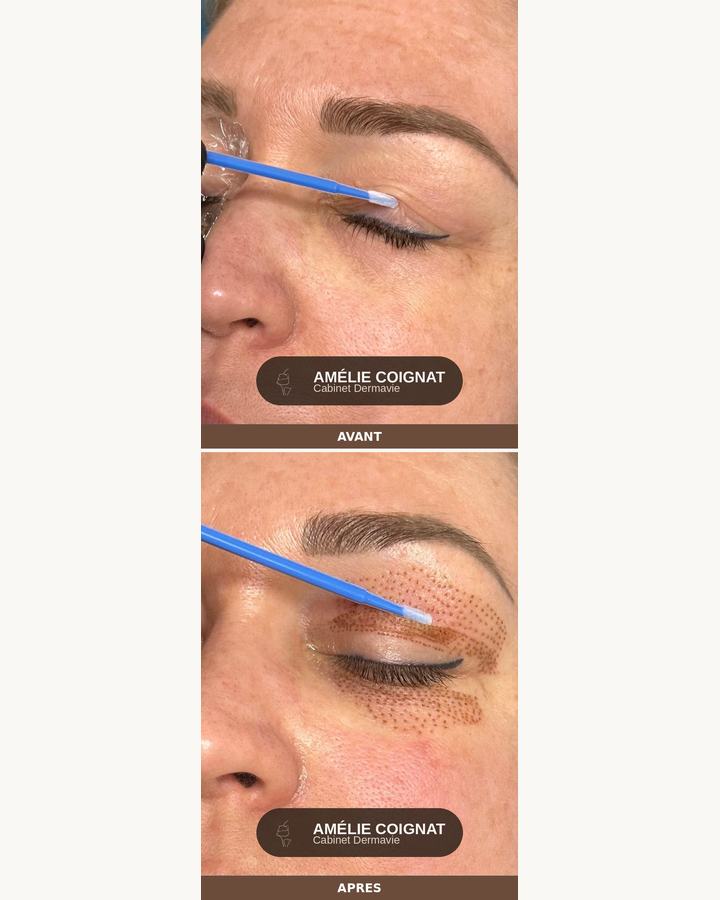 Plasma pen periorbital 2, avant/après - Cabinet Dermavie Sainte-Maxime