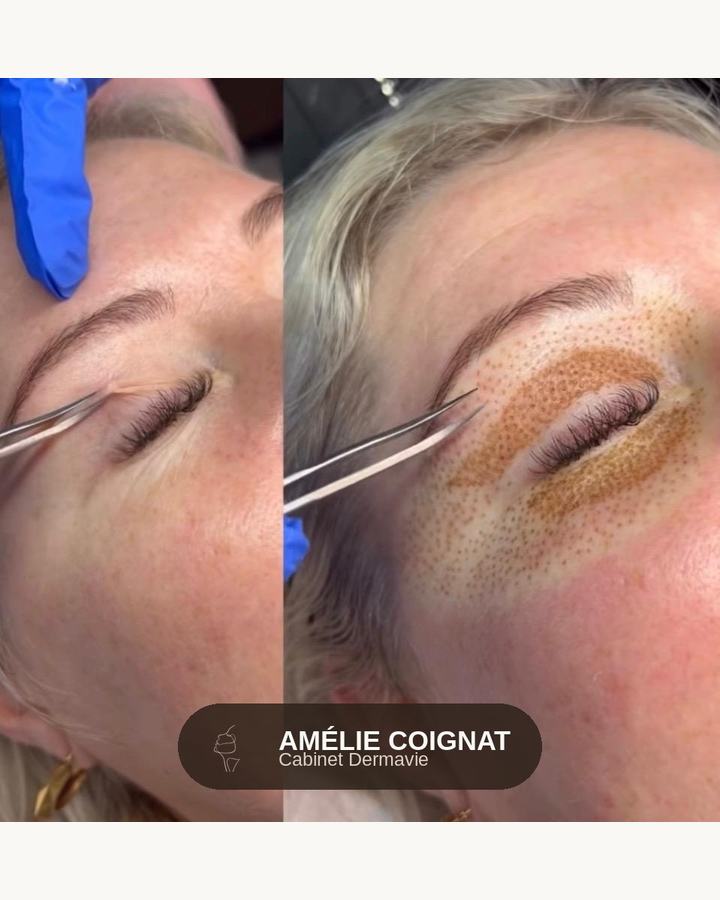 Plasma pen periorbital geste - Cabinet Dermavie Sainte-Maxime
