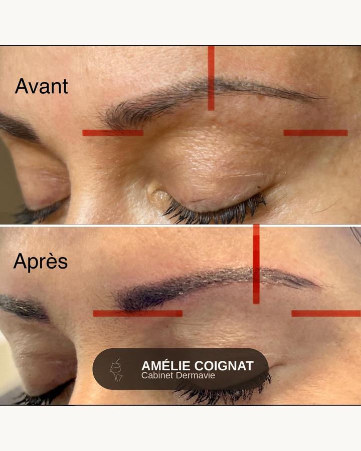 Correction ligne - Cabinet Dermavie Sainte-Maxime