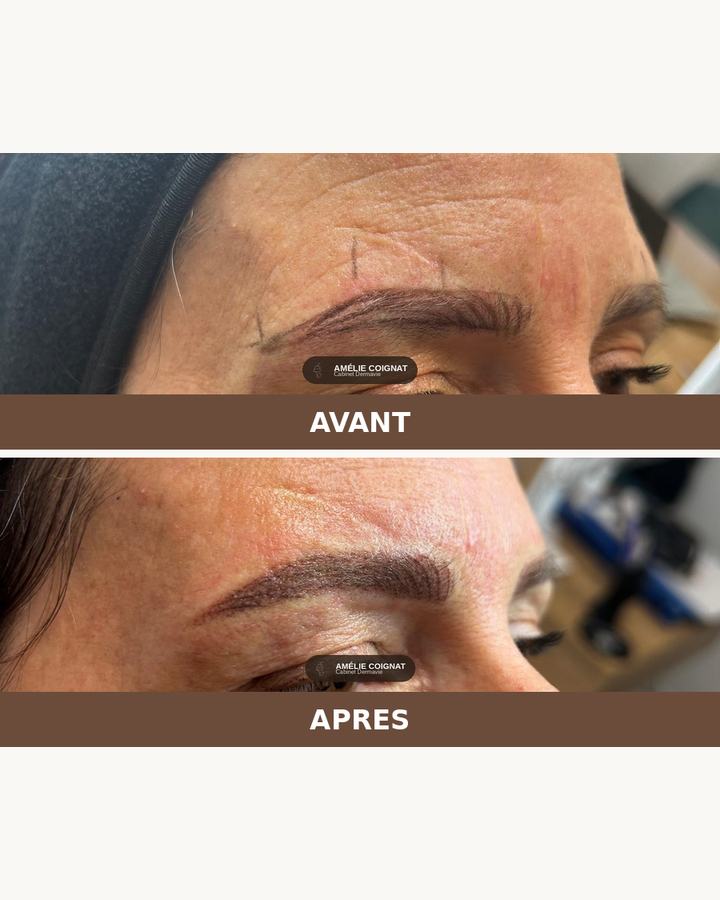 Dermopigmentation mixte, avant/après - Cabinet Dermavie Sainte-Maxime