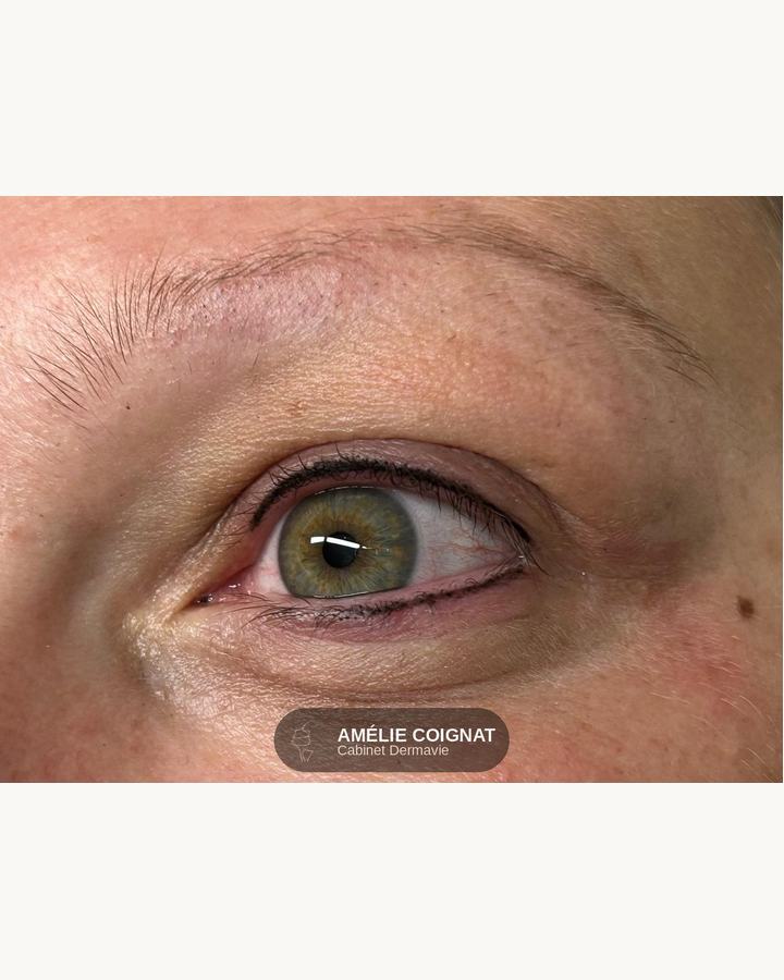 Intensification intracilaire - Cabinet Dermavie Sainte-Maxime