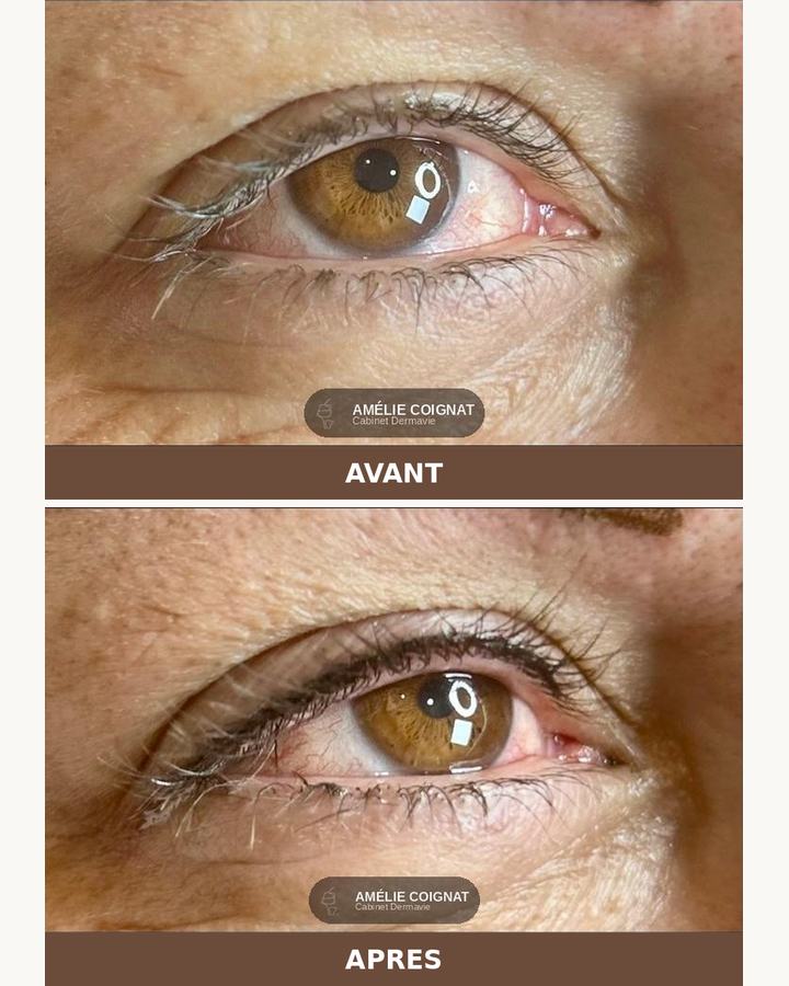 Lashliner mature, avant/après - Cabinet Dermavie Sainte-Maxime