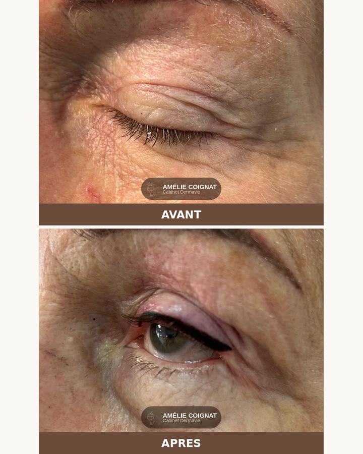Liner peau mature, avant/après - Cabinet Dermavie Sainte-Maxime