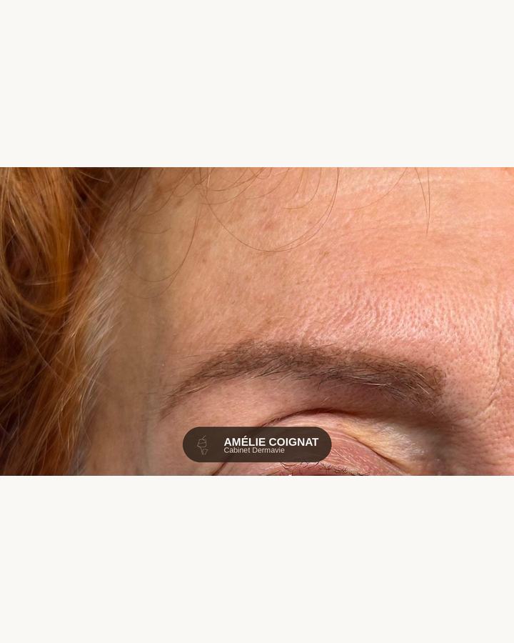 Microshading leger phototype clair - Cabinet Dermavie Sainte-Maxime