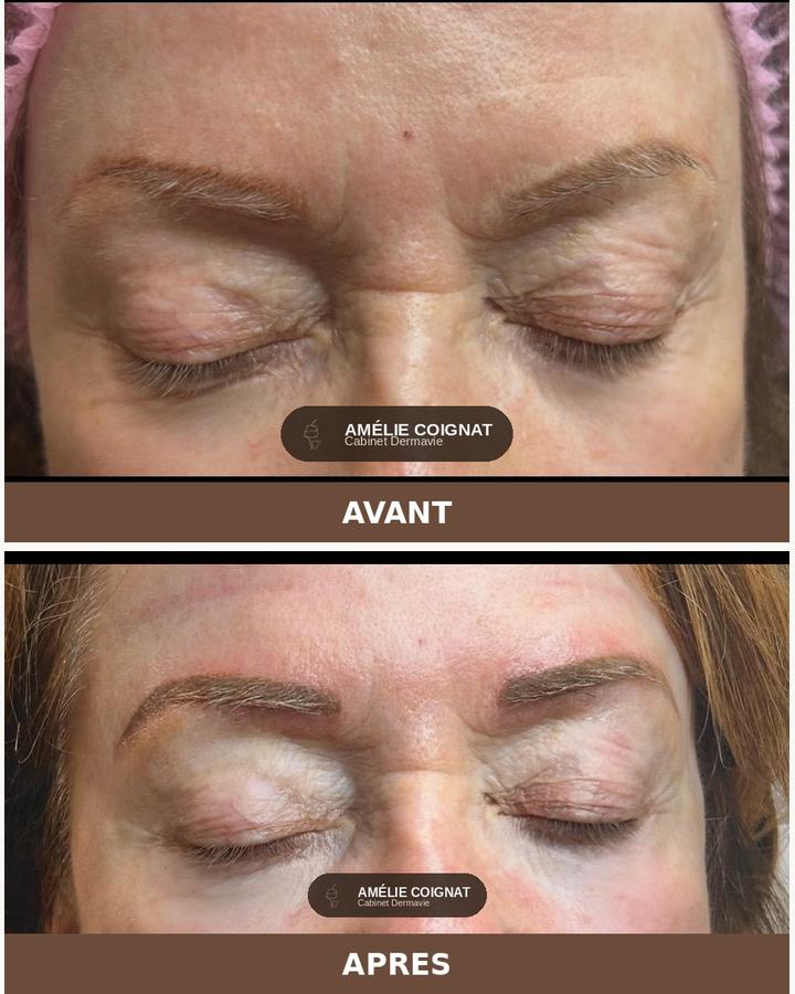 Microshading mature, avant/après - Cabinet Dermavie Sainte-Maxime