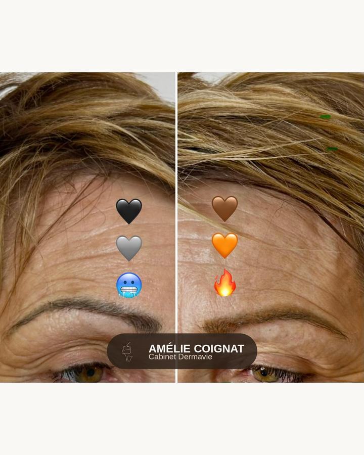 Neutralisation couleur - Cabinet Dermavie Sainte-Maxime