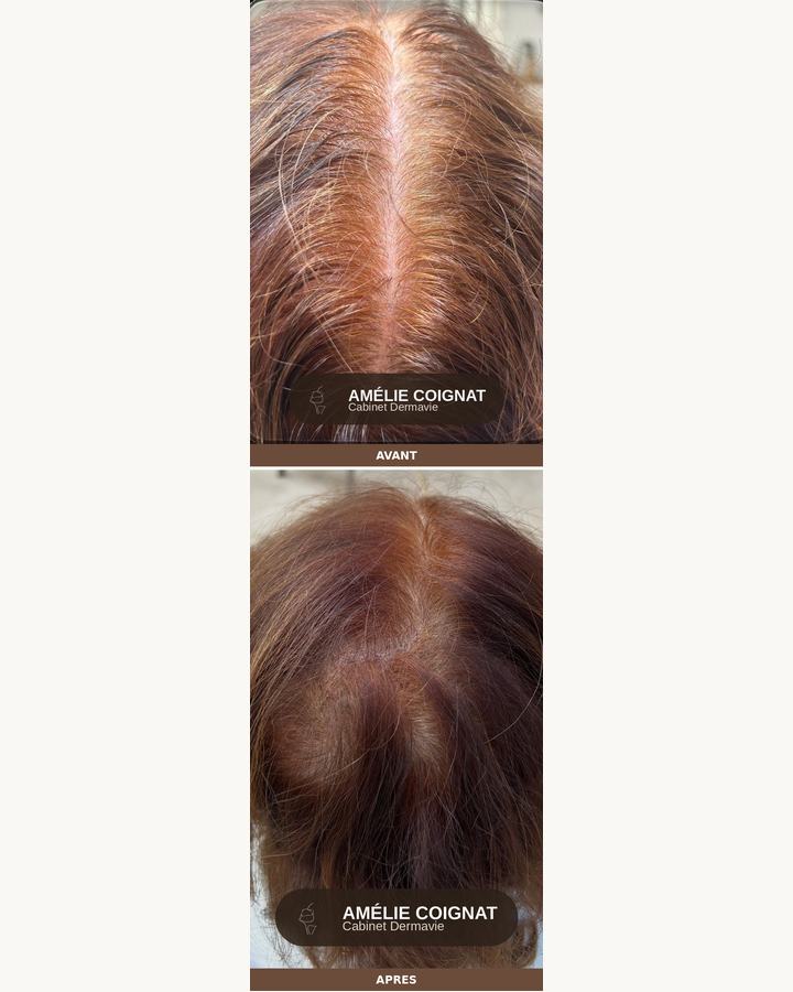 Capillaire femme, avant/après - Cabinet Dermavie Sainte-Maxime